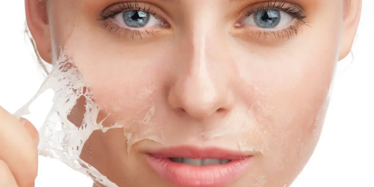 Kimyasal Peeling